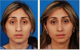 Illustration for article titled Nose Reshaping/Rhinoplasty